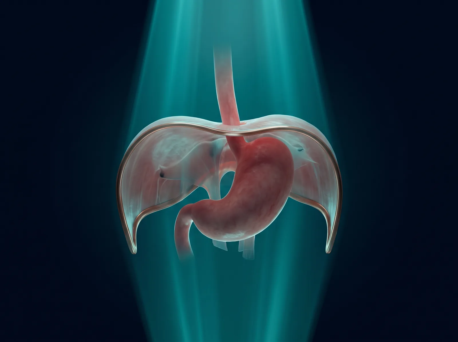 Medical illustration of the diaphragm with the esophagus passing through it, showing the upper part of the stomach pushed up above the diaphragm through the opening, which is a hiatal hernia.